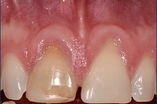 Recession on Central Incisors - Before Treatment