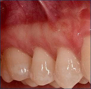 Recession on Upper Bicuspid - After Treatment