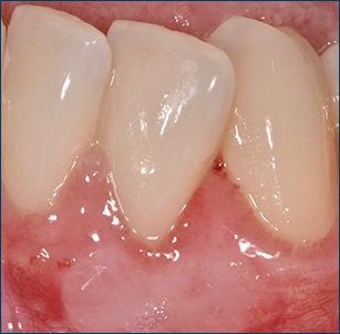 Gingival Recession – After Grafting