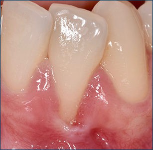 Gingival Recession – Before Grafting